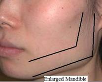 A large lower jaw (mandible) can cause a wide lower face.